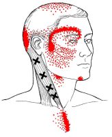 Headache Trigger Points and Referral
